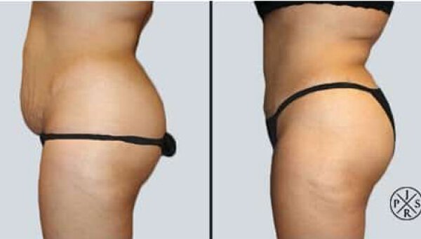 before and after photo abdominoplasty Sydney