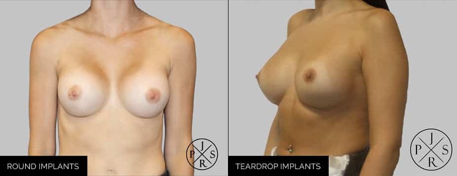 Sydney breast implant before and after photo
