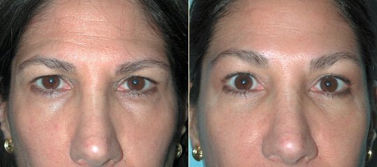 Sydney Brow Lift patient before and after photo