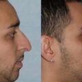 Cosmetic Surgery for Australian Men