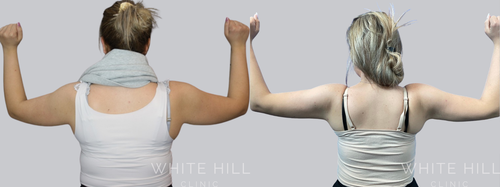 Arm Liposuction Sydney Before and After - White Hill Clinic