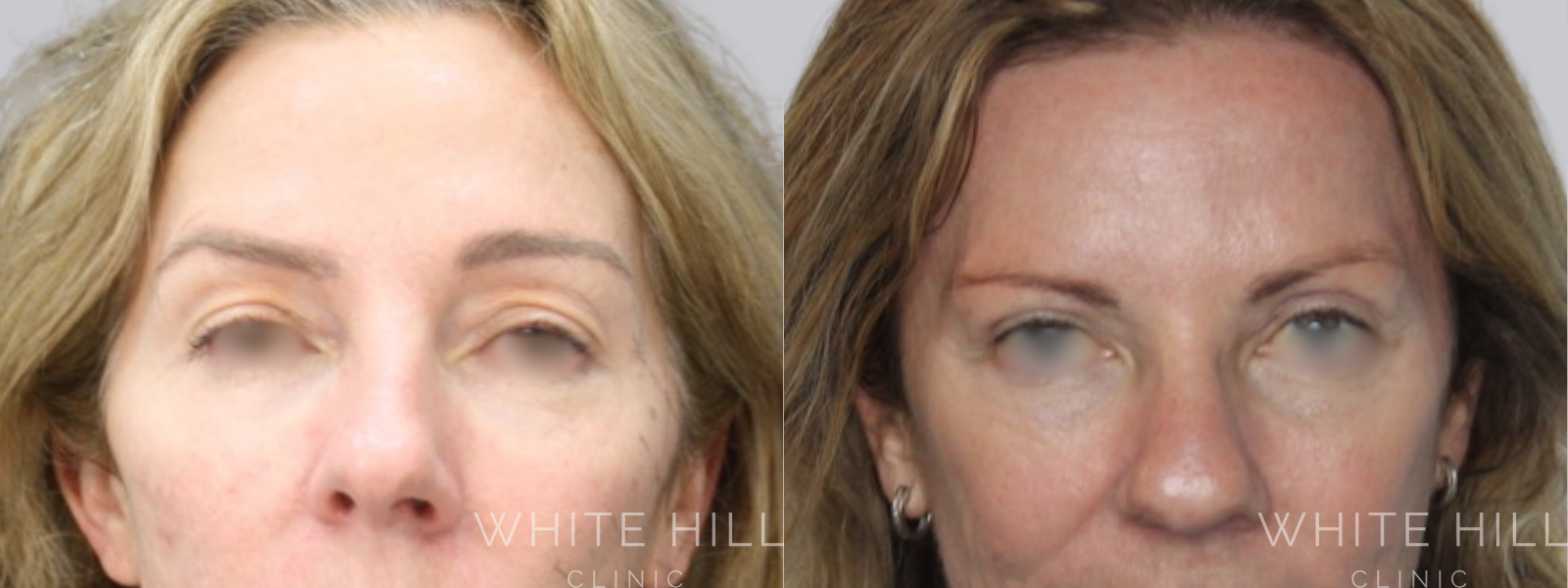 Blepharoplasty Before & After