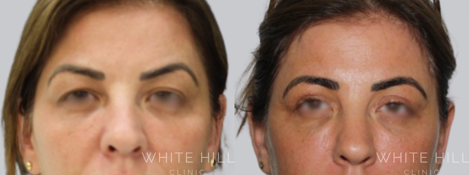 Blepharoplasty Before & After