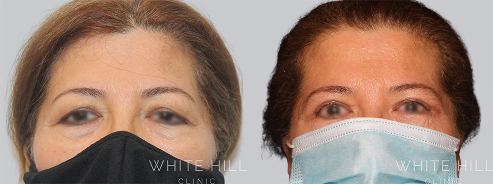 Blepharoplasty Before & After