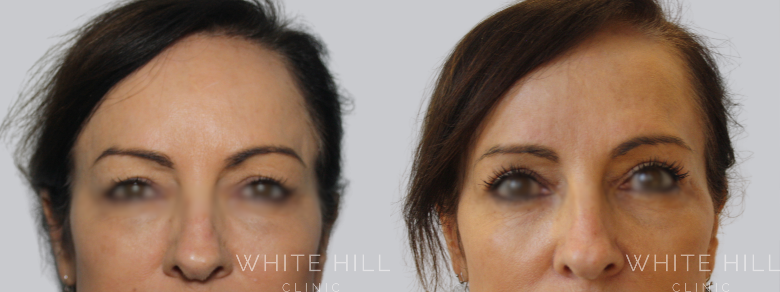 Blepharoplasty Surgery Sydney Before and After