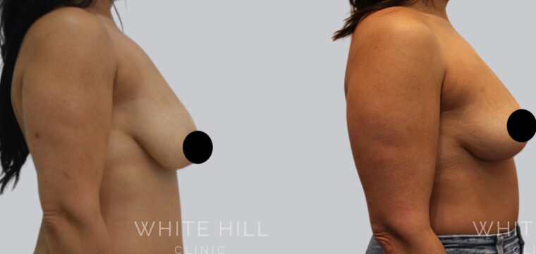 Breast Fat Transfer Sydney White Hill Clinic