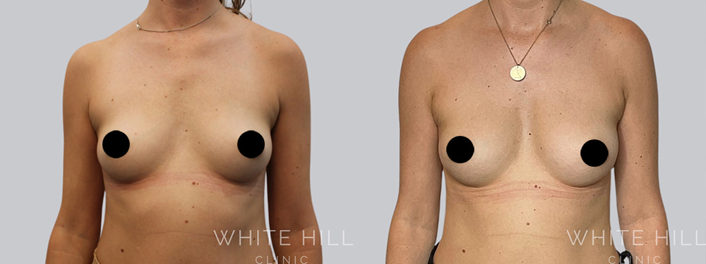 Breast Fat Transfer Before and After Surgery Sydney White Hill Clinic