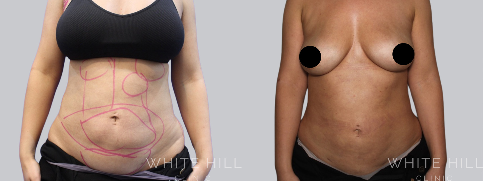 Full Body Liposuction Surgery Sydney Before and After