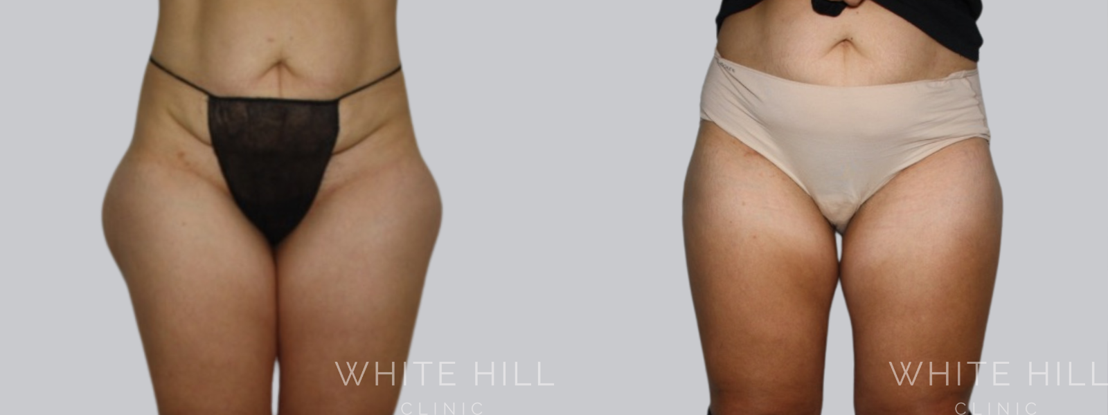 Lower Body Liposuction Procedure Sydney Before and After - White Hill Clinic