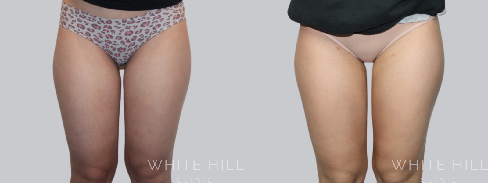 Lower Body Liposuction Surgery Sydney - White Hill Clinic