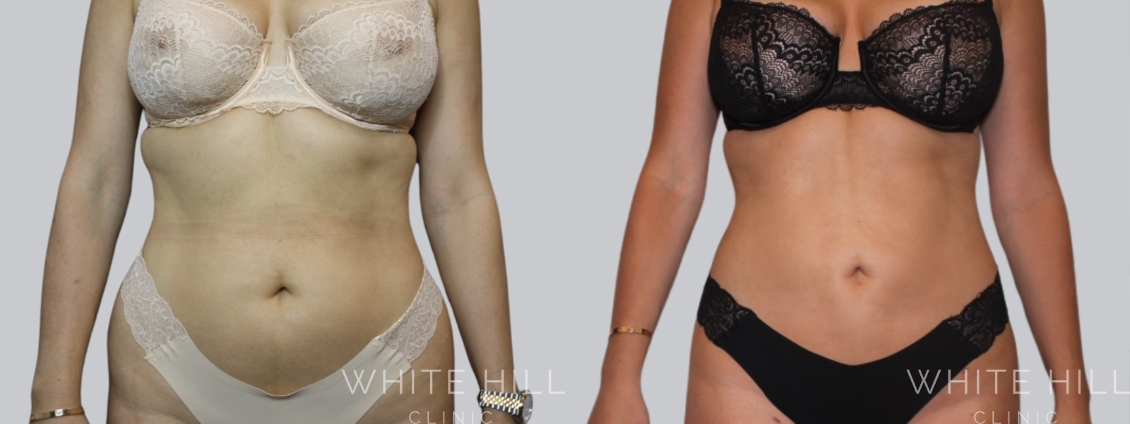 Stomach Liposuction Before and After Sydney - White Hill Clinic