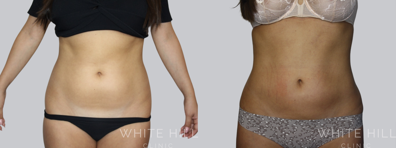 Stomach Liposuction Before and After Sydney - White Hill Clinic