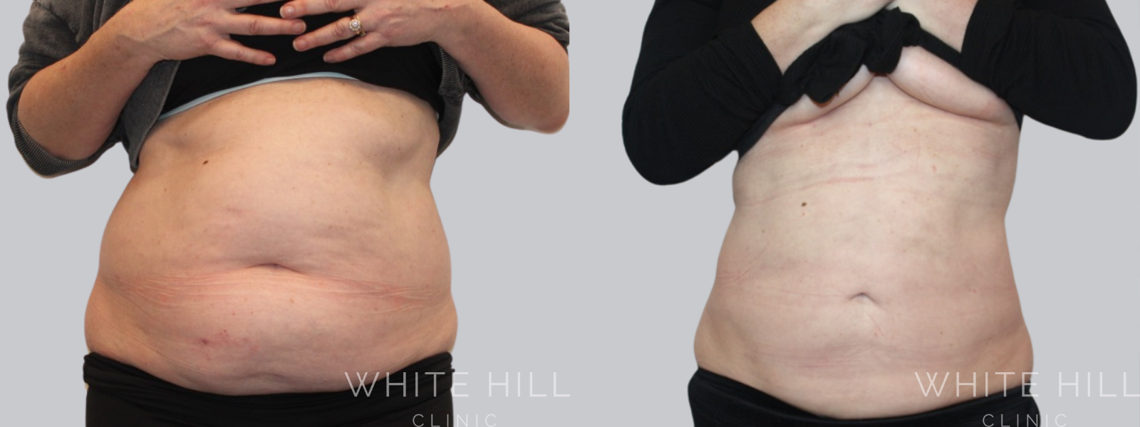Stomach Liposuction Before and After Sydney - White Hill Clinic