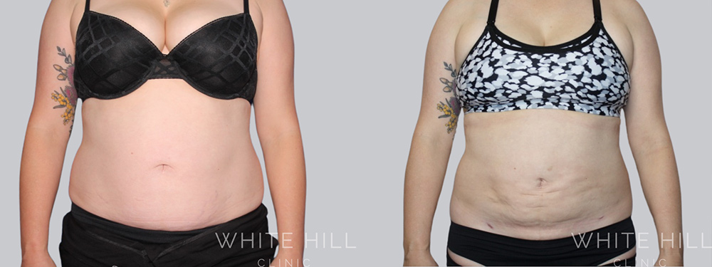 Abdomen Liposuction Surgery Sydney Before and After