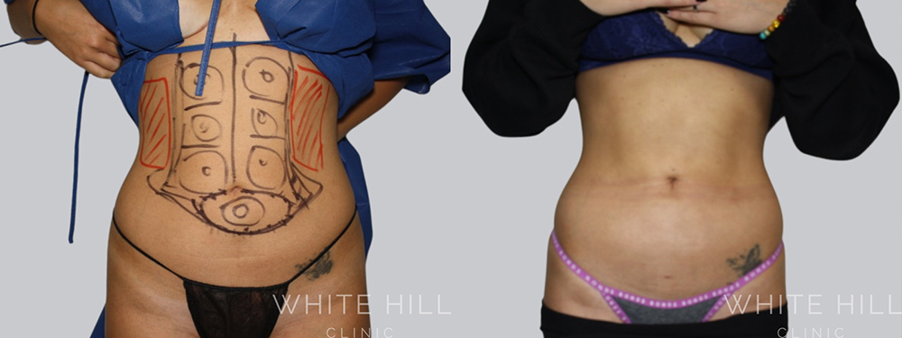 Abdomen Liposuction Surgery Sydney Before and After