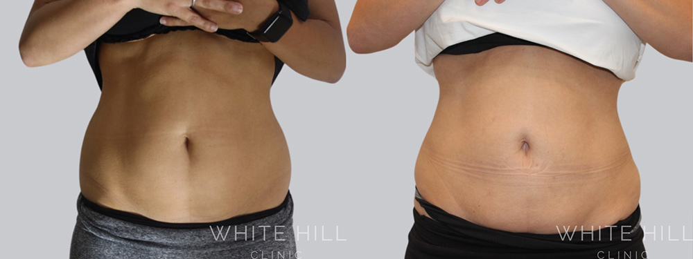 Abdomen Liposuction Surgery Sydney Before and After
