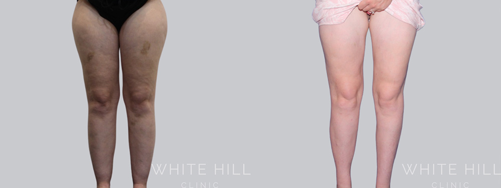 Thigh Liposuction Surgery Sydney Before and After