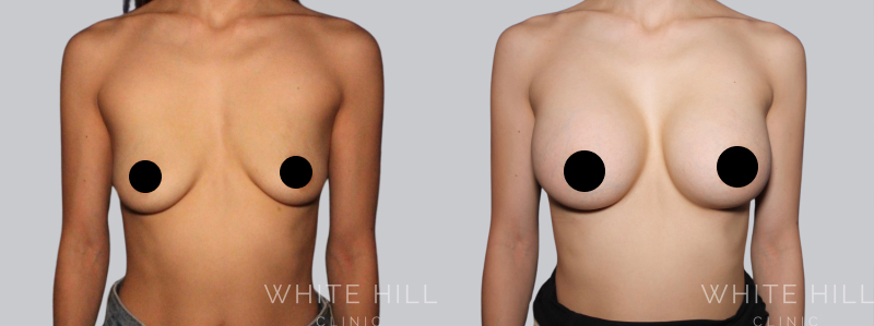 breast augmentation before after