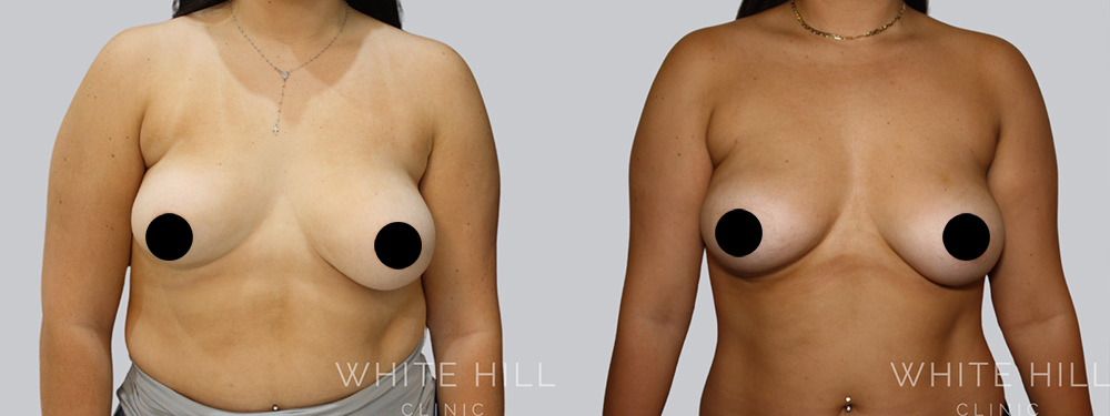 Breast Fat Transfer Before and After Surgery Sydney White Hill Clinic