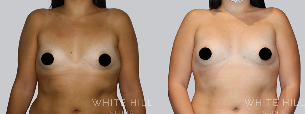 Breast Fat Transfer Before and After Surgery Sydney White Hill Clinic