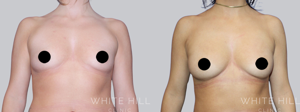 Breast Fat Transfer Before and After Surgery Sydney White Hill Clinic