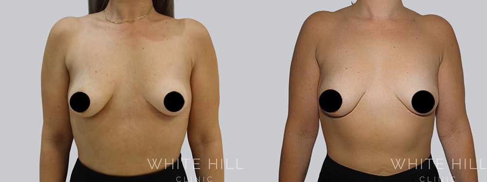 Breast Fat Transfer Before and After Surgery Sydney White Hill Clinic