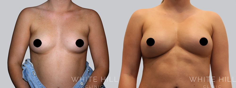 Breast Fat Transfer Before and After Surgery Sydney White Hill Clinic