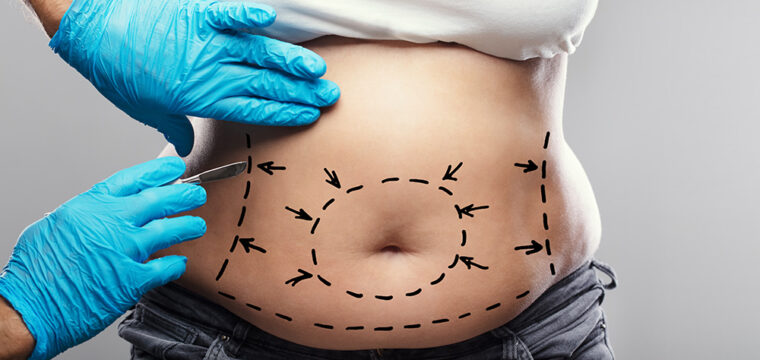 life after liposuction