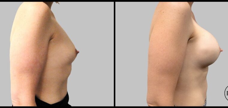 What Is A Total Breast Reconstruction