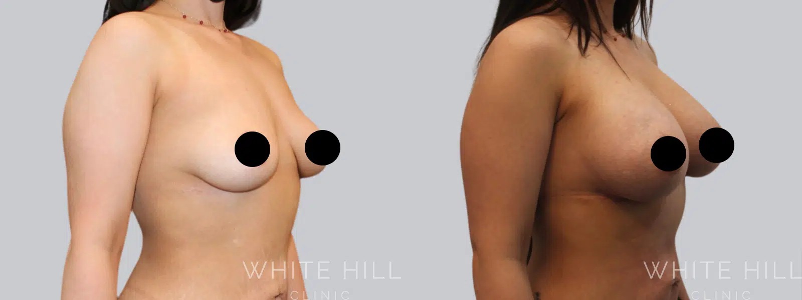 breast augmentation recovery, breast augmentation recovery rest, post-surgery healing, breast implant recovery