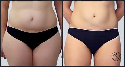 Can Liposuction Last Forever?