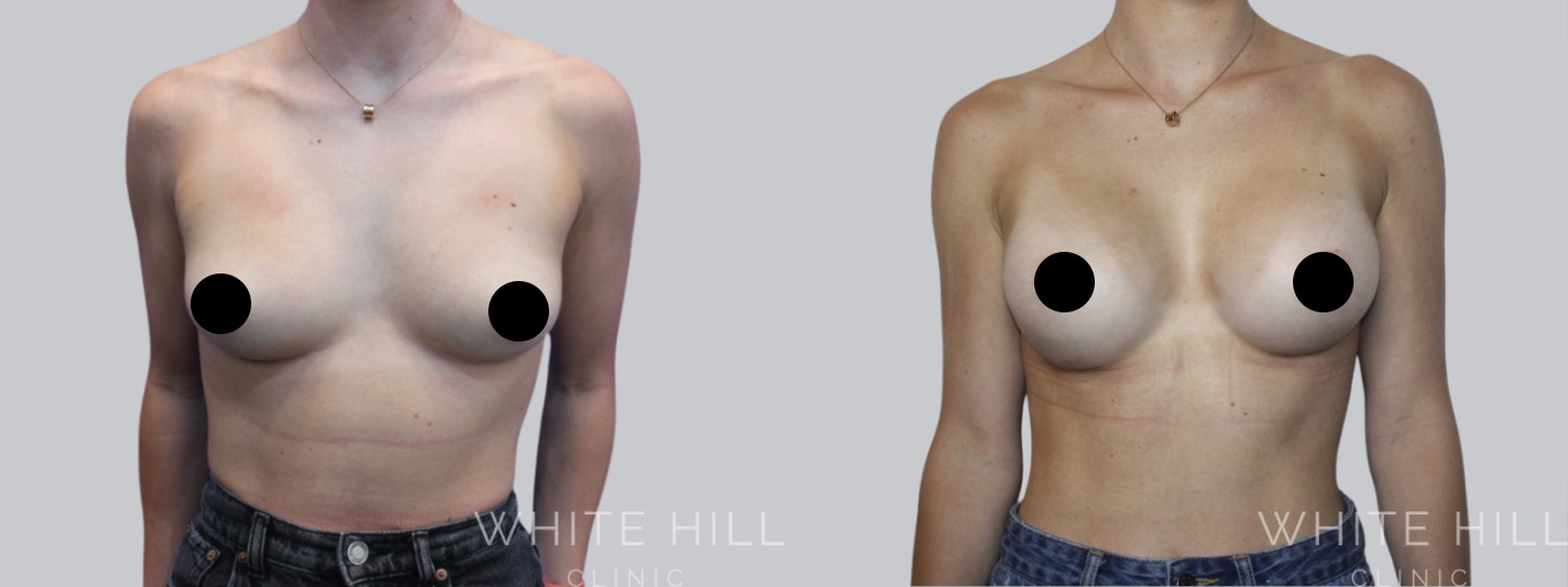 Breast Enhancement Sydney White Hill Clinic