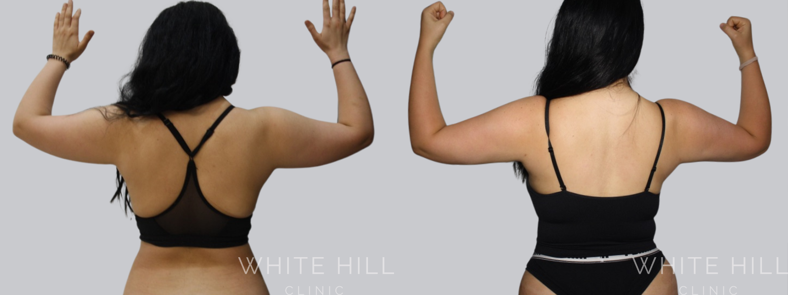 Arm Liposuction Before and After Sydney