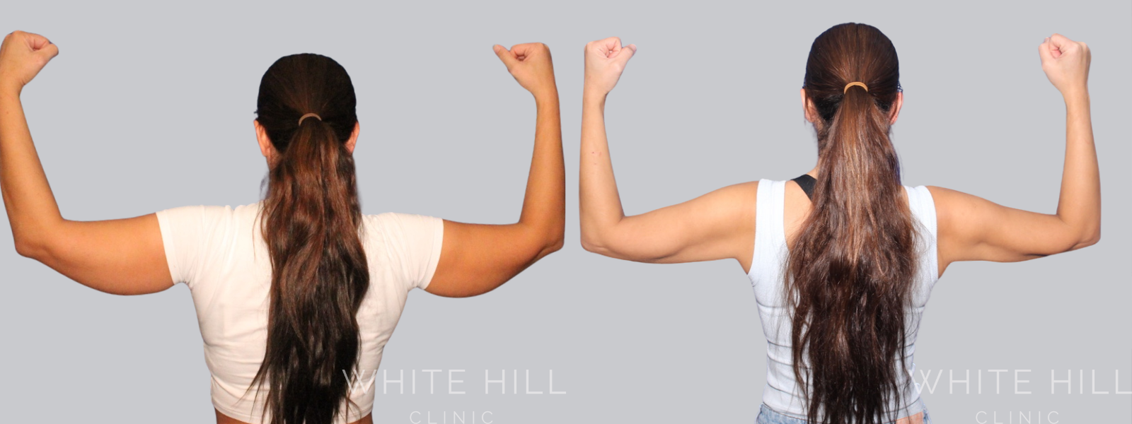 Arm Liposuction Before and After Sydney