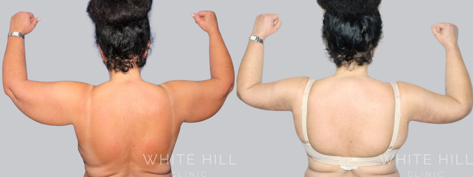 Brachioplasty Sydney Before and After
