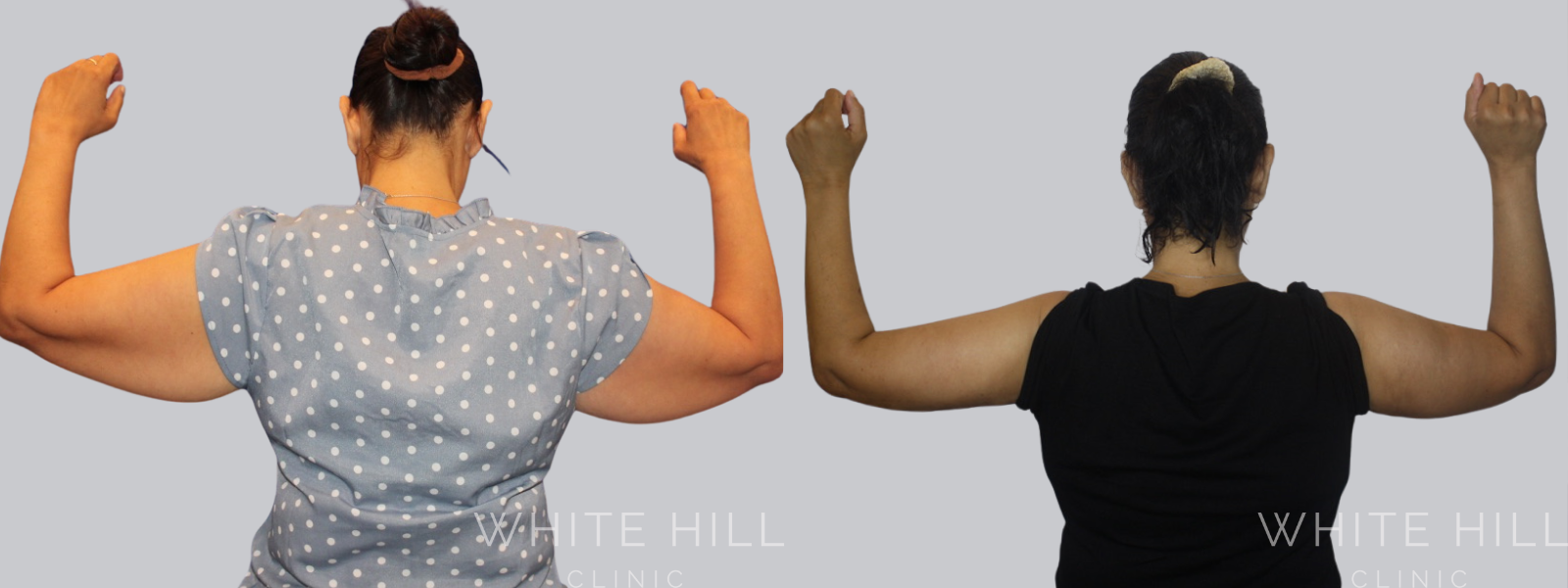 Brachioplasty Sydney Before and After