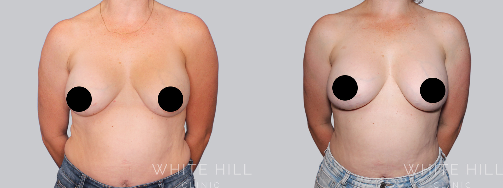 Breast Implant Revision Before and After Sydney