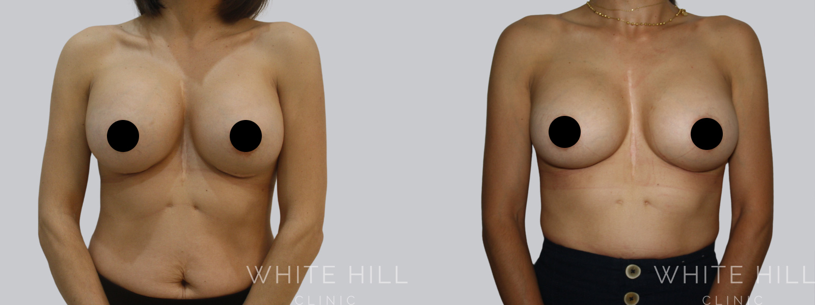 Breast Implant Revision Before and After Sydney