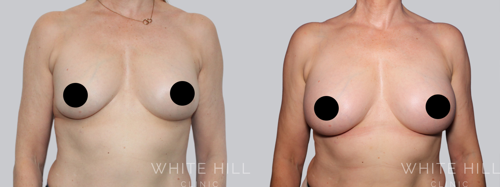 Breast Implant Revision Before and After Sydney