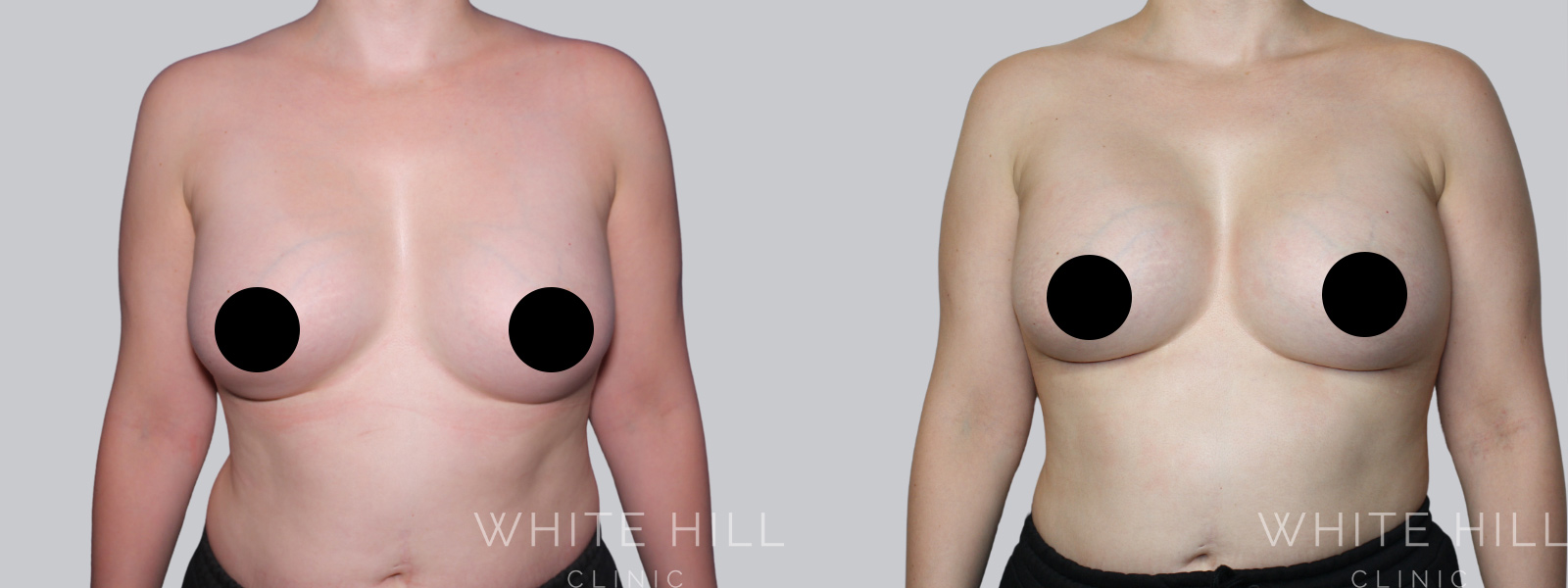 Breast Implant Revision Before and After Sydney