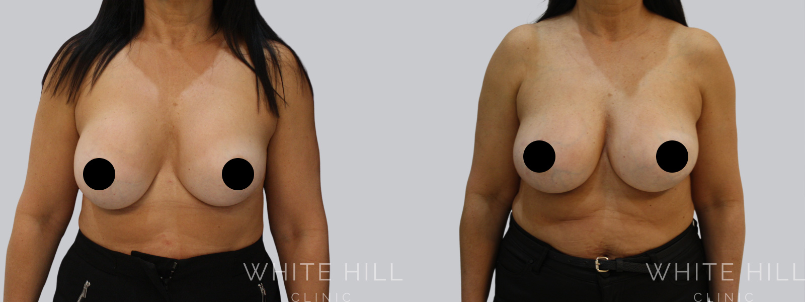 Breast Implant Revision Before and After Sydney