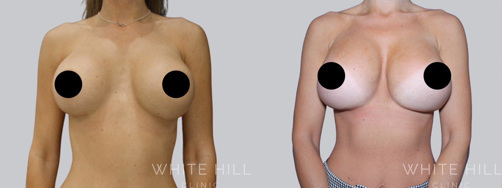 Breast Implant Revision Before and After Sydney