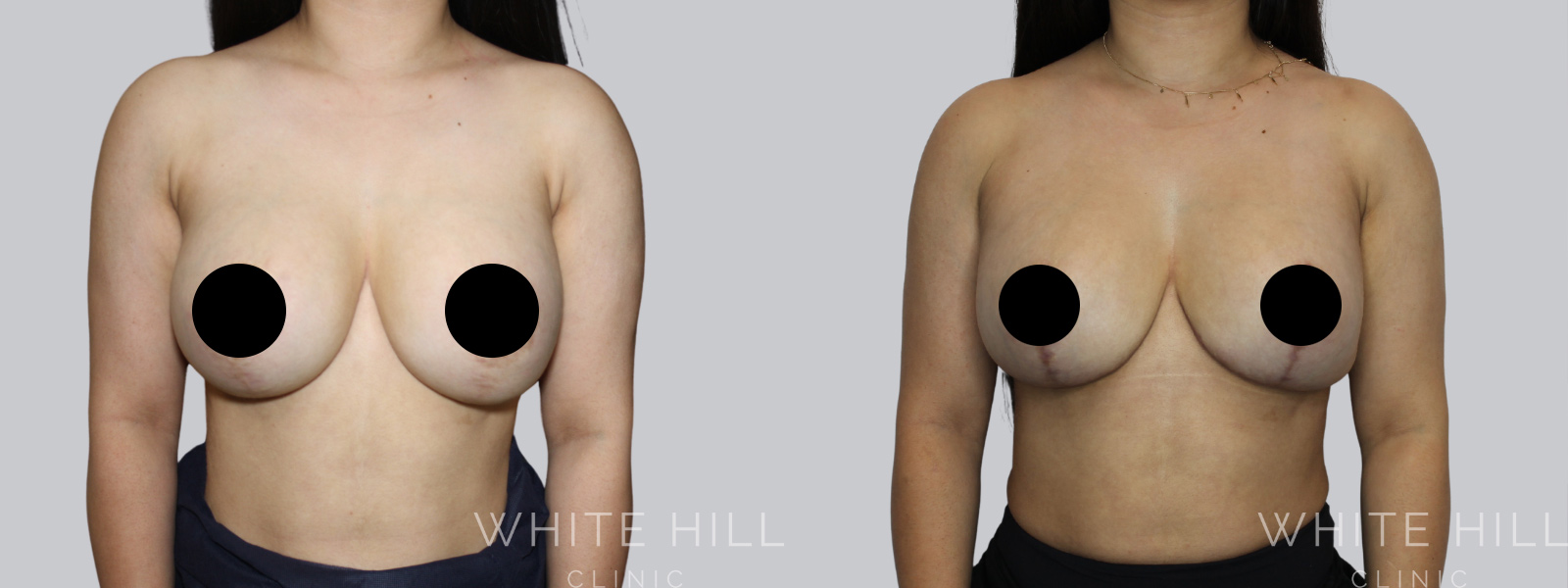 Breast Implant Revision Before and After Sydney