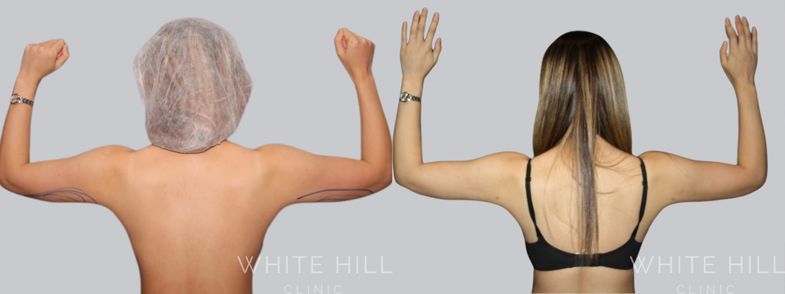 Arm Liposuction Before and After Sydney