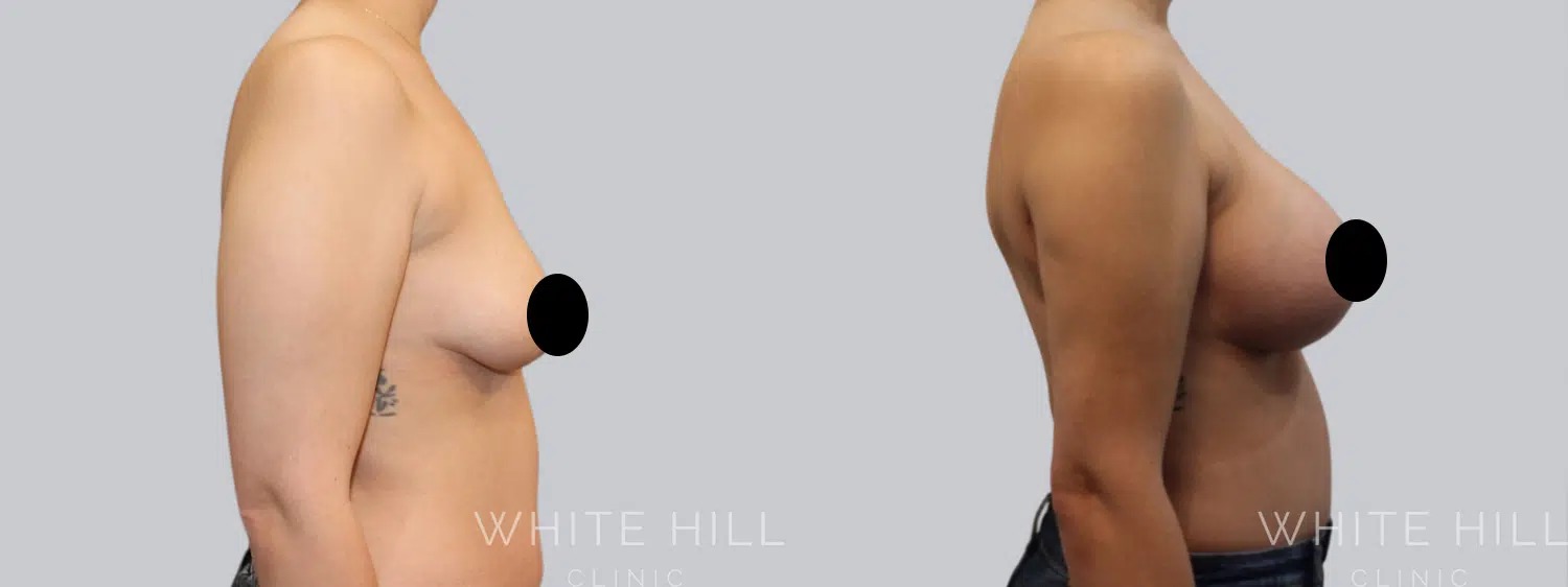 teardrop vs round implants