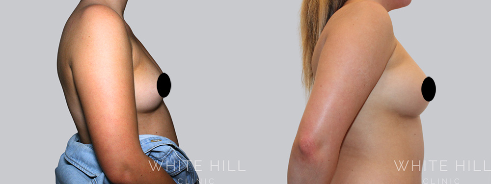 fat transfer to breast pros and cons, natural breast augmentation, minimal scarring