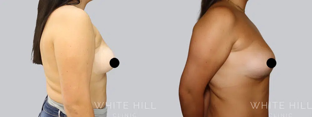 how many cc of fat can be transferred to breasts fat transfer to breasts breast fat transfer procedure breast augmentation with fat transfer fat grafting to breasts fat transfer breast augmentation