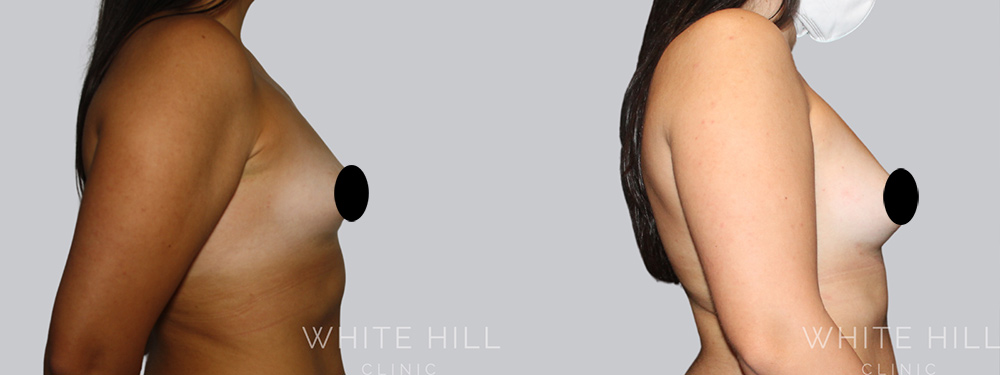 how to retain fat after breast fat transferbreast fat transfer fat transfer to breasts fat transfer breast augmentation fat retention after fat grafting fat graft survival maximise fat retention